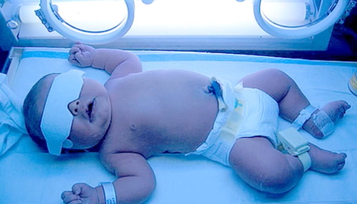 Icter neonatal - Adeomed