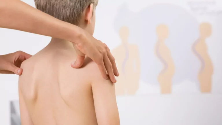 scolioza la copii, ortopedie pediatrica