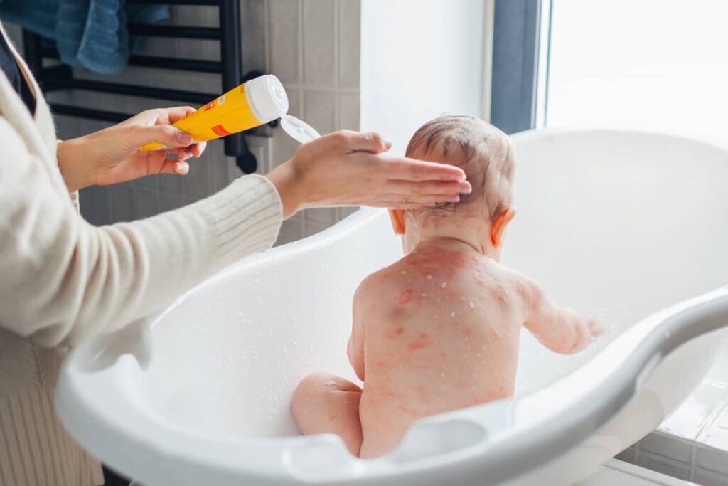 Dermatita atopica eczema 1024x683