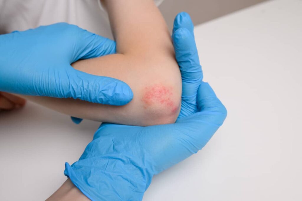 Dermatita de contact 1024x681