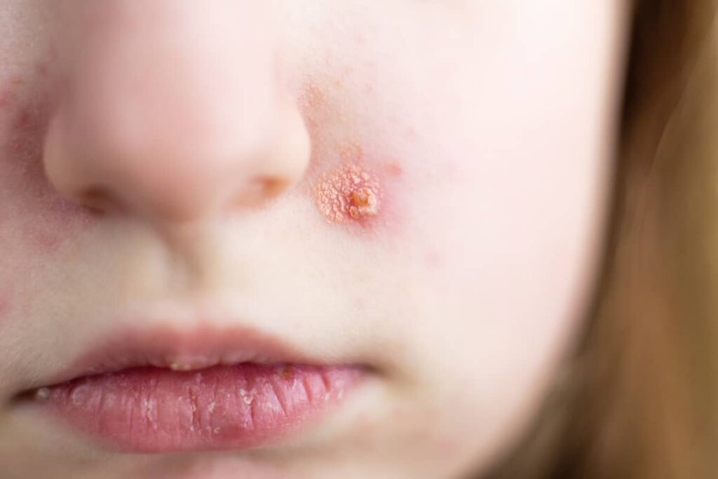 Impetigo 1024x683