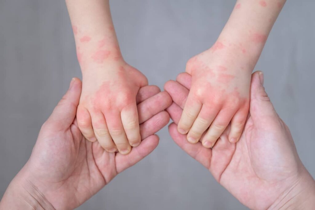 Consultație dermatologie pediatrică